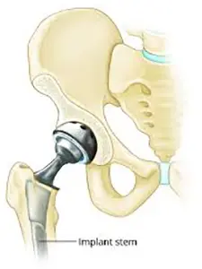 hip replacement
