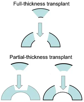 Cornea transplant